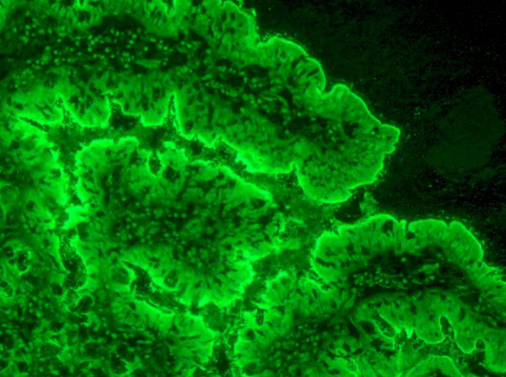 Image: Indirect immunofluorescence on a patient’s intestinal lining shows anti-enterocyte antibodies. Enterocytes are the cells of the intestinal lining (Photo courtesy of the NIH).