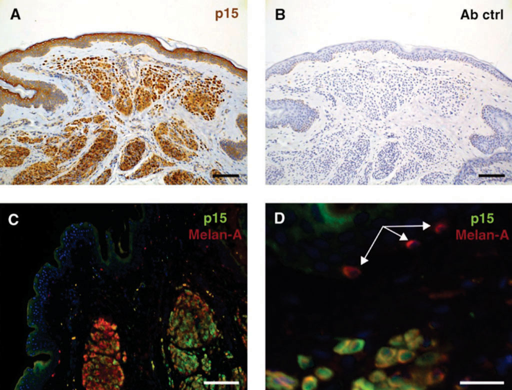 Image: p15 expressed in nevi is a key factor mediating BRAF-induced growth arrest. A, p15 expression in a benign intradermal nevus and B, antibody control C, co-immunofluorescence of p15 and Melan-A in a representative intradermal benign nevus. D, nevus melanocytes express p15, whereas non- nevus melanocytes (white arrows) are p15-negative (Photo courtesy of University of Pennsylvania).