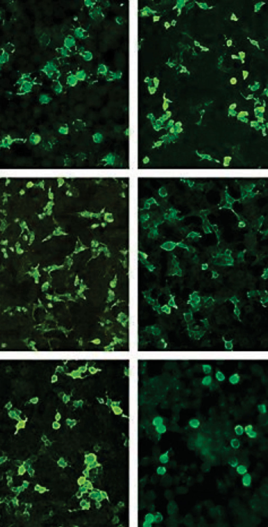 Image: Immunohistochemistry of transfected cells: antibodies against NMDAR and CASPR2 (top), AMPAR1 and LGI1 (middle), AMPAR2 und GABAB-R (bottom) (Photo courtesy of Euroimmun).