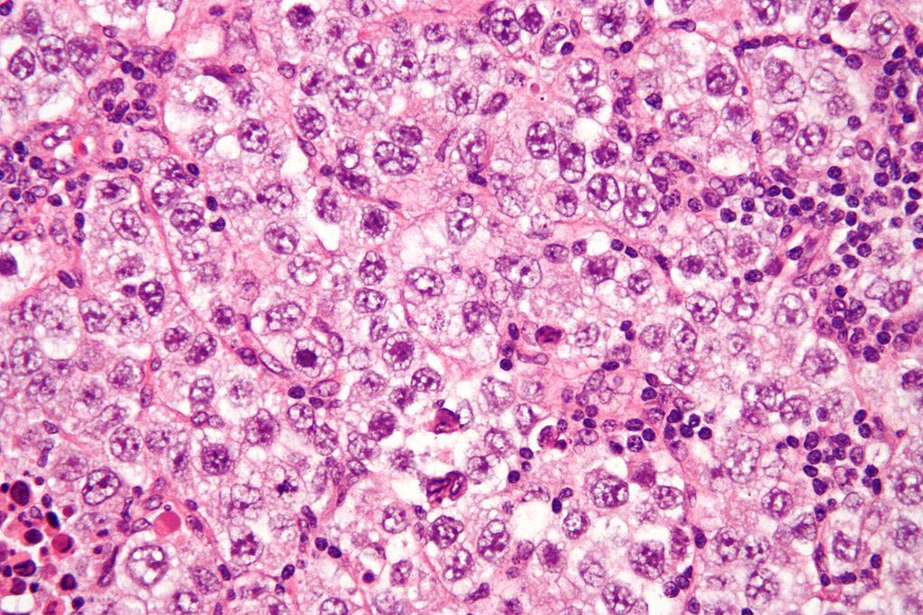 Image: A micrograph of a seminoma, a common germ cell tumor. Tumor cells show a fried egg-like appearance (Photo courtesy of Wikimedia Commons).