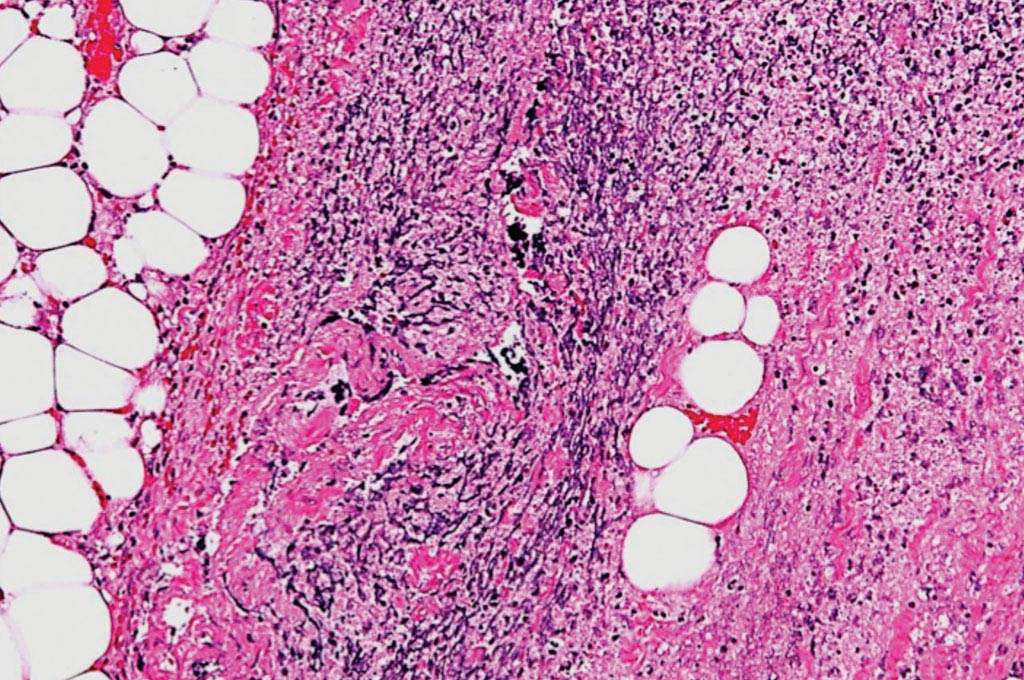 Image: A histopathology of necrotizing fasciitis of the skin showing amorphous grey or pink material and neutrophils (Photo courtesy of Nephron).