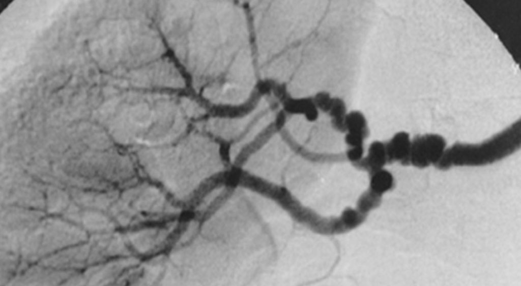 Image: Fibromuscular dysplasia (FMD) of renal arteries. Image shows \"string-of-beads\" arterial lesions, a feature of multi-focal FMD caused by areas of relative stenoses alternating with small aneurysms. The diameters of the aneurysms exceed the normal diameter of the artery, a sign characteristic of medial FMD. A similar bead appearance may be seen in perimedial FMD, but the diameters of the beads do not exceed the normal diameter of the artery. Note the involvement of branch renal arteries (Photo courtesy of the Journal of Rare Diseases).