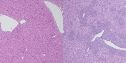 Image: Members of the TET protein family protect against cancer. Left: Normal liver in mice with fully functional TET proteins. Right: Without TET2 and TET3, mice develop a lethal disease resembling lymphoma within weeks of birth, their livers overloaded with iNKT cells (Photo courtesy of Dr. Angeliki Tsagaratou, La Jolla Institute for Allergy and Immunology).