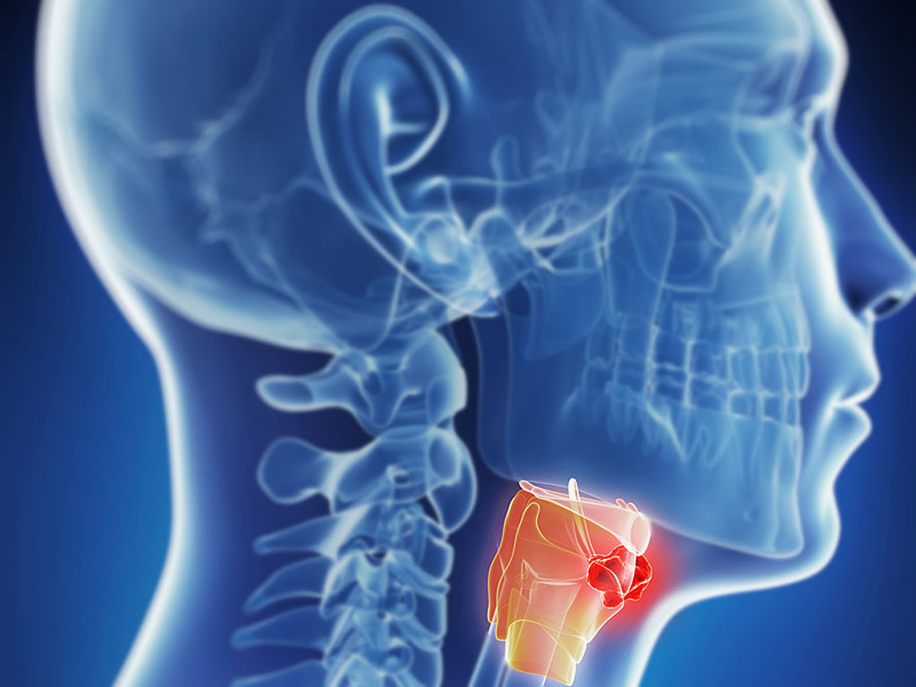 Image: Research suggests that following the levels of antibodies directed against the human papilloma virus\' E6 and E7 proteins could be an accurate method for predicting whether a patient being treated for oropharyngeal cancer will experience recurrence of the disease (Photo courtesy of Medscape).