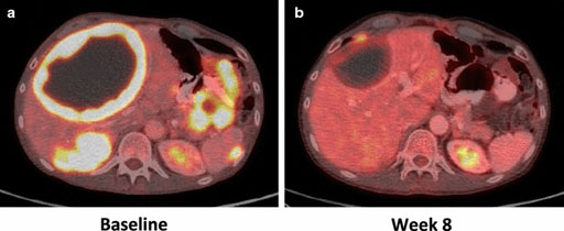 Image: Radiological response of a Gastrointestinal Stromal Tumor (GIST) possessing an ETV6–NTRK3 fusion following treatment with LOXO-101, a selective TRK inhibitor. A 55-year old male with a T3N0M1 small intestine GIST had progression of disease on five lines of tyrosine kinase inhibitors targeting KIT prior to identification of an ETV6–NTRK3 fusion in the tumor. He was enrolled on a Phase I clinical trial of oral LOXO-101 (Loxo Oncology, Stamford, CT, USA), a selective TRK inhibitor. As compared to baseline PET/CT images (a), the tumors had decreased size and FDG-uptake at week 8 (b). At 4 months, the patient had ongoing partial response (44%) according to RECIST 1.1 criteria (Photo courtesy of the Journal of Translational Medicine).