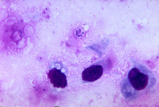 Image: Pneumocystis jirovecii is present in this lung impression smear, using Giemsa stain. This fungus is arguably the most important cause of pneumonia in the immunocompromised human host (Photo courtesy of the CDC).