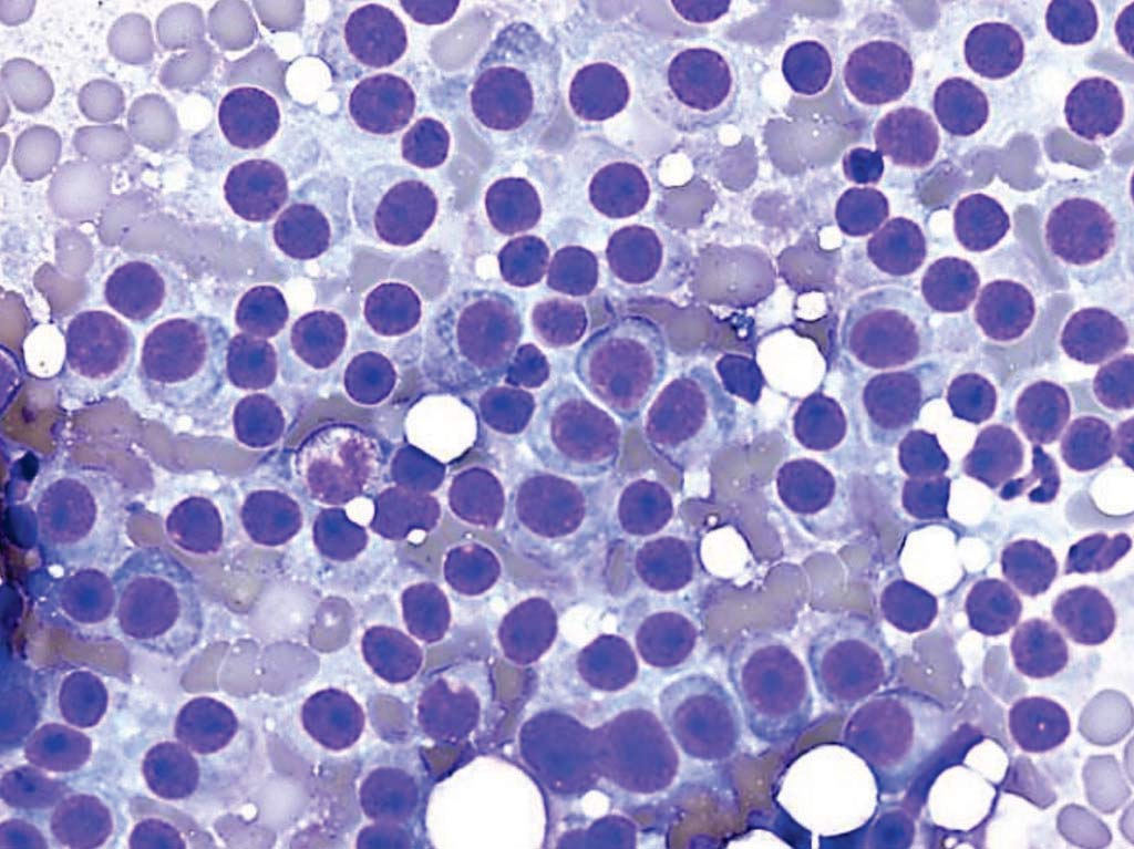 Image: A photomicrograph of bone marrow aspirate from a patient with multiple myeloma, showing numerous plasma cells, which can be recognized by the eccentric nucleus and perinuclear halo (Photo courtesy of Dr. Michael G. Bayerl).