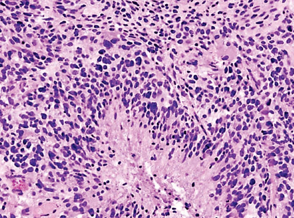 Image: A histopathology of cerebral glioblastoma showing marked cellularity, with marked hyperchromatism and pleomorphism. Note the prominent vascularity as well as the area of necrosis at the left with neoplastic cells palisading around it (Photo courtesy of KGH).