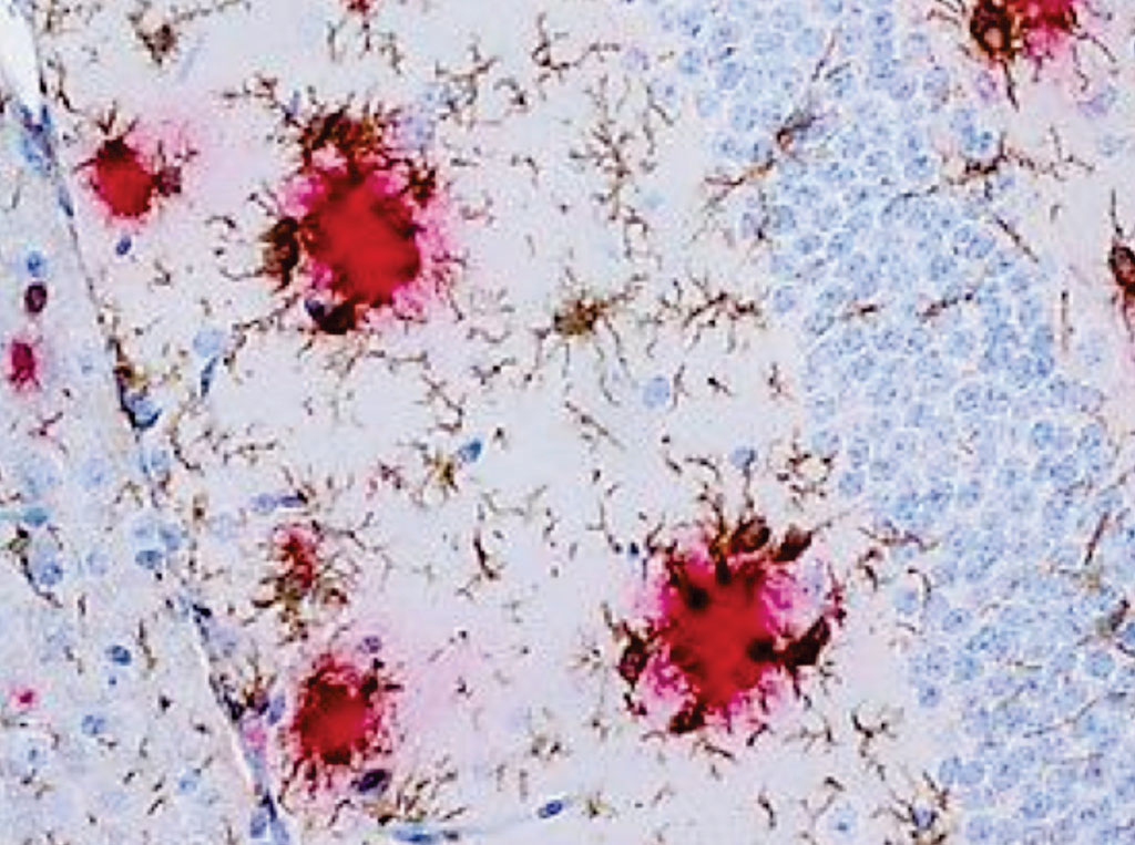 Image: A histology of immune cells of the brain, the microglia (brown), cluster around the beta-amyloid deposits (red) in an Alzheimer’s disease model (Photo courtesy of Frank Heppner/ Charité).