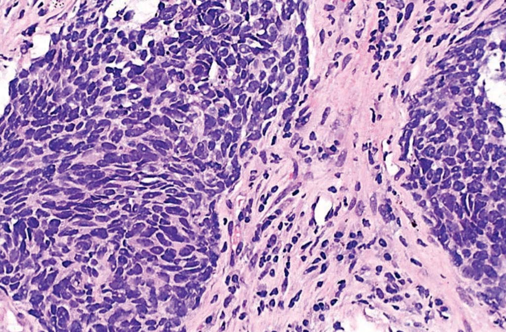 Image: A histopathology of a non-small cell lung carcinoma (Photo courtesy of Librepath).