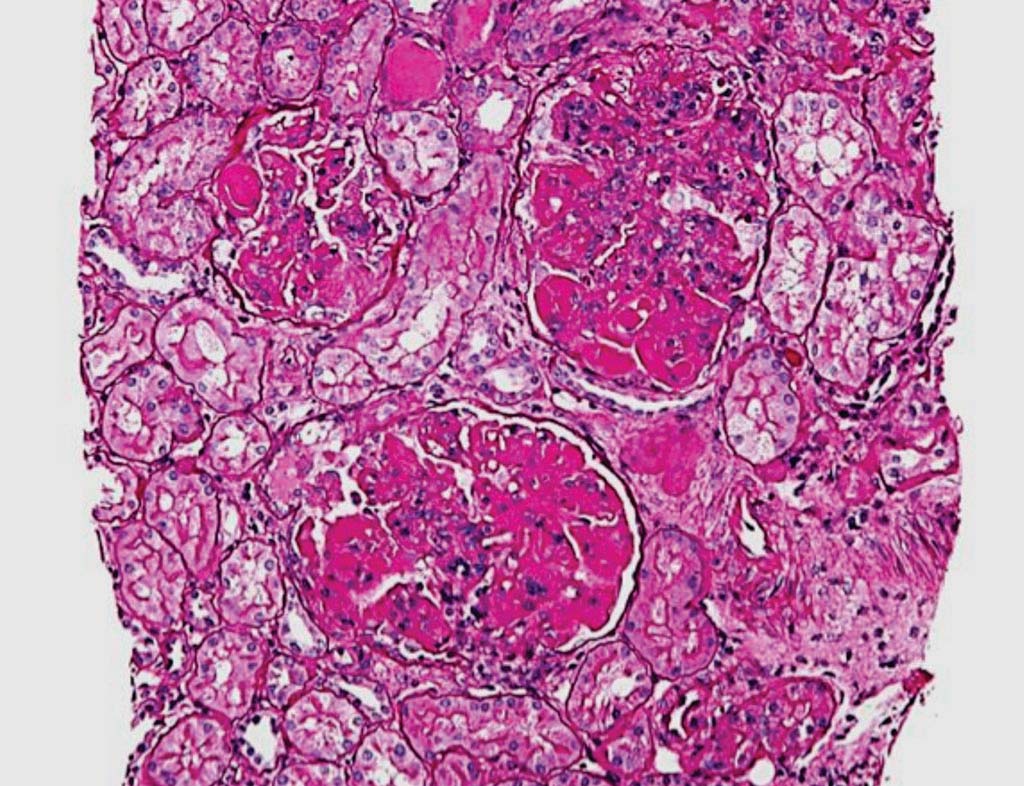 Image: A histopathology of a kidney biopsy showing diffuse proliferative lupus nephritis with increased mesangial matrix and mesangial hypercellularity (Photo courtesy of Nephron).