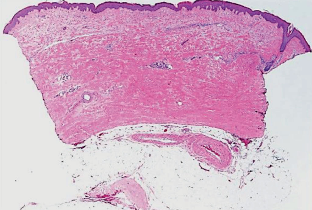 Image: A histopathology of a skin-punch biopsy specimen in a patient with systemic sclerosis (Photo courtesy of Dr. Soumya Chatterjee, MD, MS, FRCP).