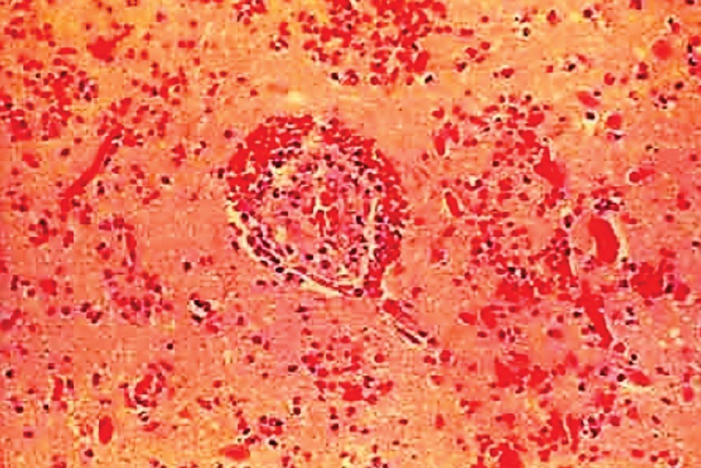 Image: A histopathology of a hemorrhagic infarction of the brain, which will typically lead to the presence of numerous hemosiderin-laden macrophages (Photo courtesy of US National Institute of Neurological Disorders and Stroke).