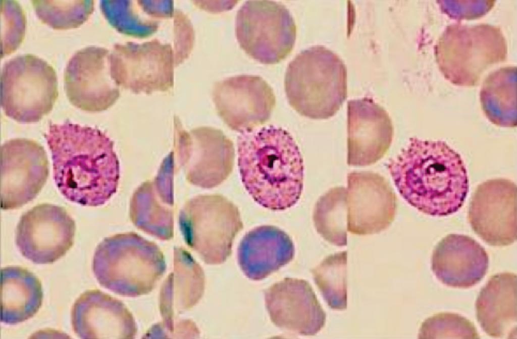 Image: Three typical trophozoites of Plasmodium ovale in a thin blood smear; note the fimbriation and Schüffner\'s dots (Photo courtesy of the Centre for Agriculture and Bioscience International).