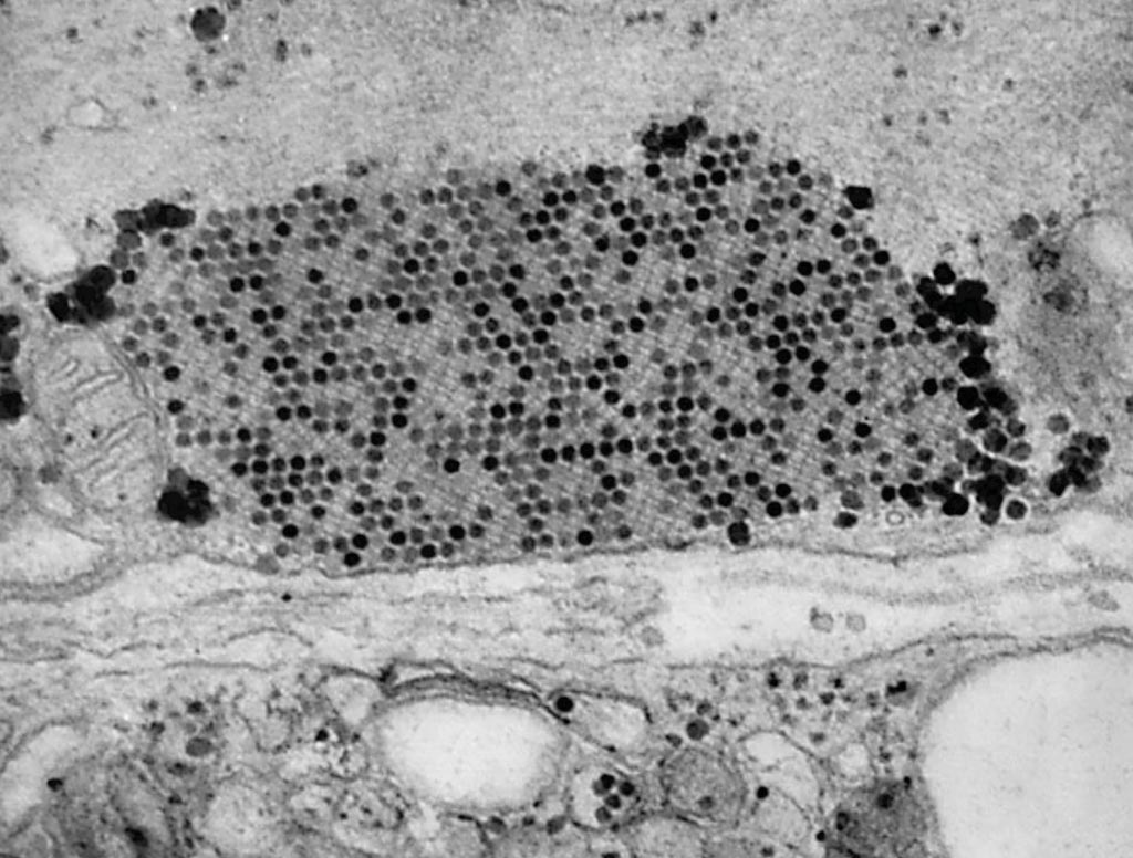 Image: A transmission electron photomicrograph (TEM) revealed the presence of coxsackievirus virus particles, which were found within a specimen of muscle tissue (Photo courtesy of Dr. Fred Murphy and Sylvia Whitfield).