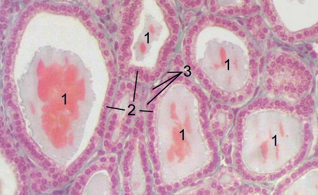Image: A photomicrograph of a thyroid gland section: (1) follicles, (2) follicular cells, (3) endothelial cells (Photo courtesy of Wikimedia Commons).