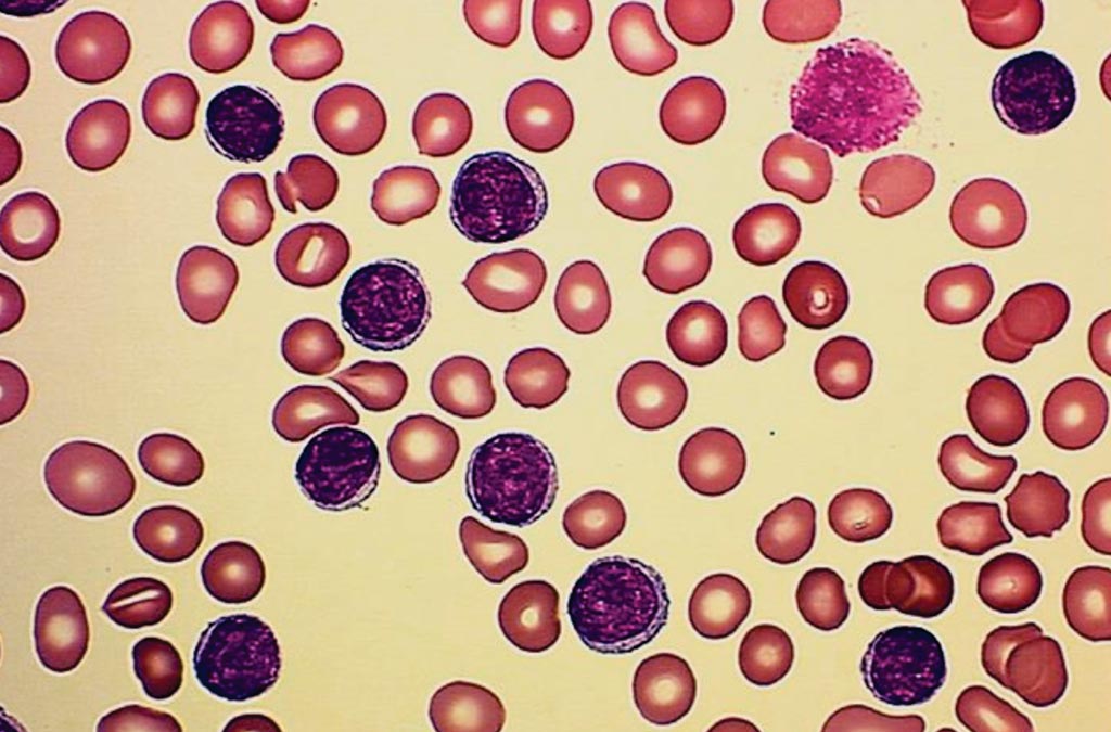 Image: Chronic lymphocytic leukemia. The peripheral blood smear shows an absolute lymphocytosis of small “mature” lymphocytes with clumped, smudgy chromatin and scant cytoplasm. Smudge cells (near the top right) are a common finding (Photo courtesy of Cleveland Clinic).