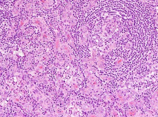 Image: A photomicrograph of lymph node tissue from a person with, idiopathic multicentric Castleman disease. Image shows increased number of blood vessels and smaller germinal centers where immune cells mature in the lymph node, which are two of the pathology features needed to make the diagnosis (Photo courtesy of Dr. David Fajgenbaum, University of Pennsylvania).