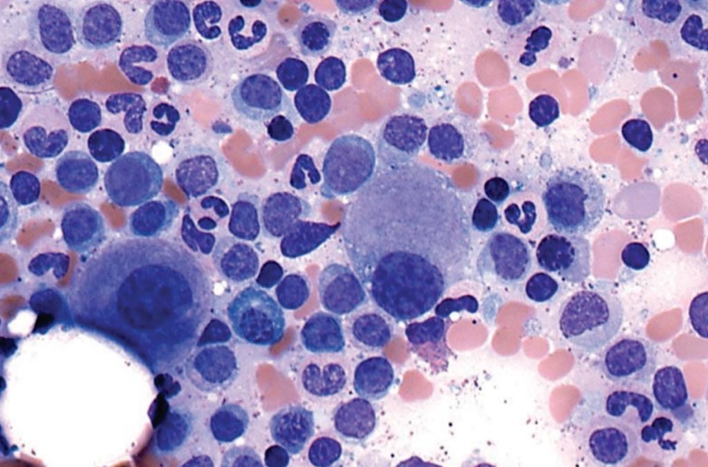 Image: Bone marrow aspirate smear from a patient with myelodysplastic syndrome showing two megakaryocytes with hypolobated, rounded nuclei are present (Photo courtesy of International Agency for Research on Cancer).