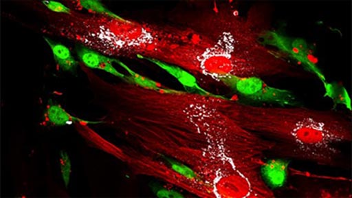 Image: An immunofluorescence photomicrograph showing breast cancer cells (green) aligned with mesenchymal stem cells (red) expressing ddr2 protein (white) (Photo courtesy of the University of Michigan).