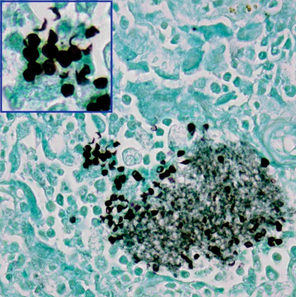 Image: A photomicrograph of lung tissue stained with Grocott-Gomori methenamine silver nitrate. Pneumocystis jirovecii organisms are highlighted as black, disc-like entities within the alveolar cast (Photo courtesy of SPL).