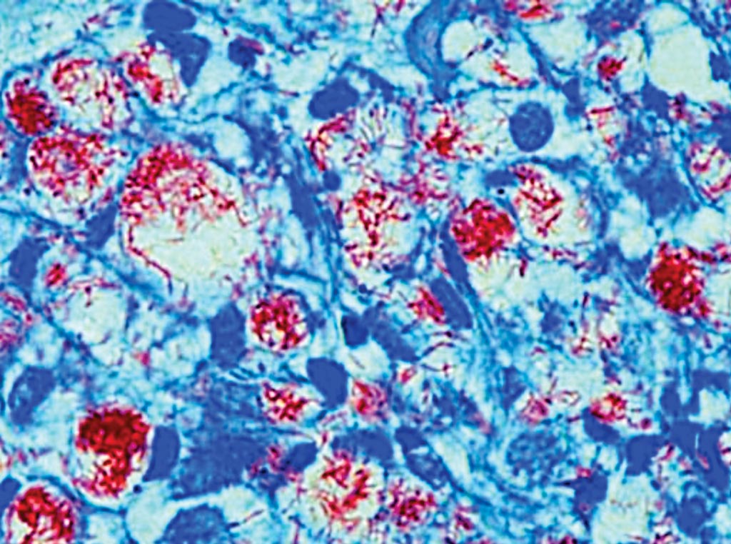 Image: A histology of lepromatous leprosy; the bacilli are densely clustered within the cytoplasmic vacuoles of foamy histiocytes (Photo courtesy of Dr. Sampurna Roy, MD).