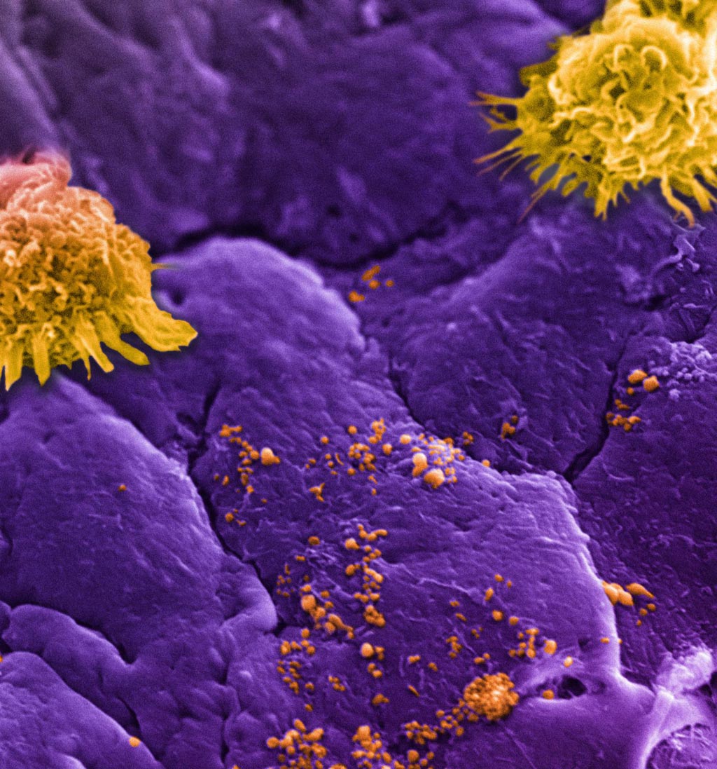 Image: Circulating white blood cells, commonly referred to as leukocytes (large yellow clusters), can be seen lining an inflamed vessel wall along with leukosomes (small yellow speckles). Leukosomes, designed to mimic white blood cells, go unnoticed as they accumulate at the inflamed vessel (purple background), allowing them to concentrate their therapeutic payload at the target site (Photo courtesy of Houston Methodist Hospital).