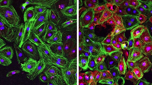 Image: Cardiomyocytes from patients with Duchenne muscular dystrophy (DMD) corrected by CRISPR-Cpf1 reframing during stemness (right) show restored dystrophin expression (red), compared to uncorrected cells (left) (Photo courtesy of Science Advances).