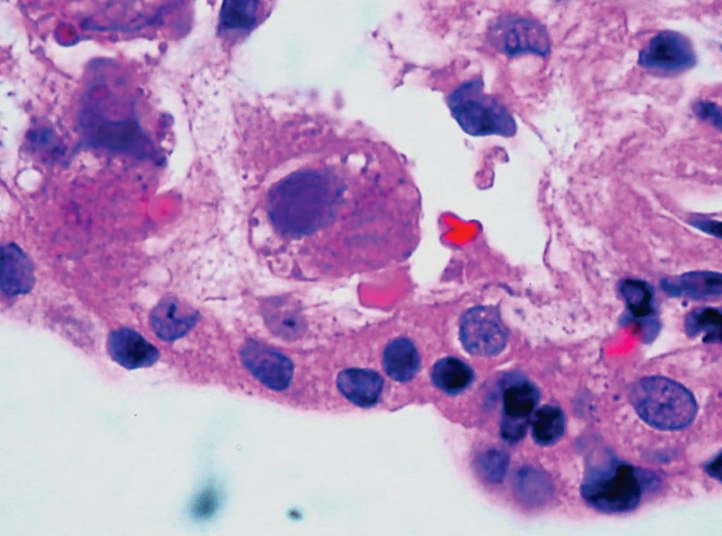 Image: A histopathology of Cytomegalovirus (CMV) Placentitis (Photo courtesy of Dr. Ed Uthman).