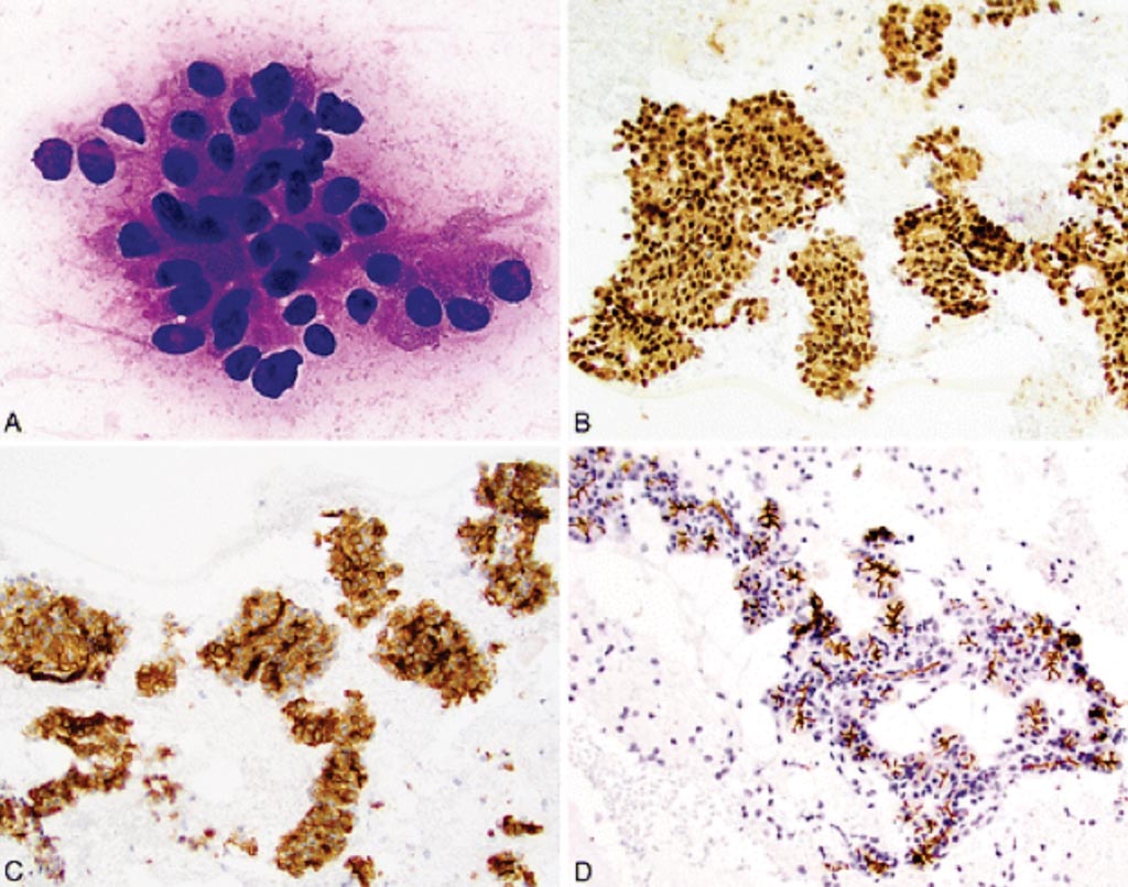 Image: An immunohistochemistry of fine needle aspirates in acinic cell carcinoma (AciCC) for SRY-related HMG-box 10 (SOX10) and 2-deoxyglucose-6-phosphate phosphatase (DOG1) (Photo courtesy of Emory University School of Medicine).