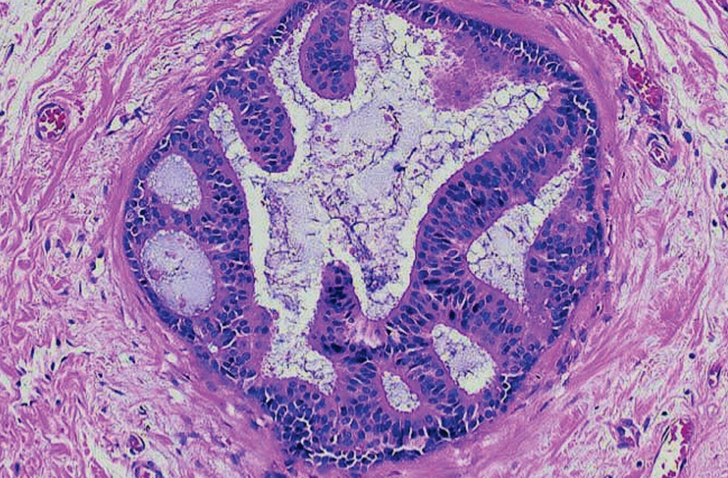 Image: A histopathology of breast cancer:  intraductal carcinoma, noncomedo type, distended duct with intact basement membrane, micropapillary, and early cribriform growth pattern membrane and central tumor necrosis (Photo courtesy of Dr. Peter Abdelmessieh).