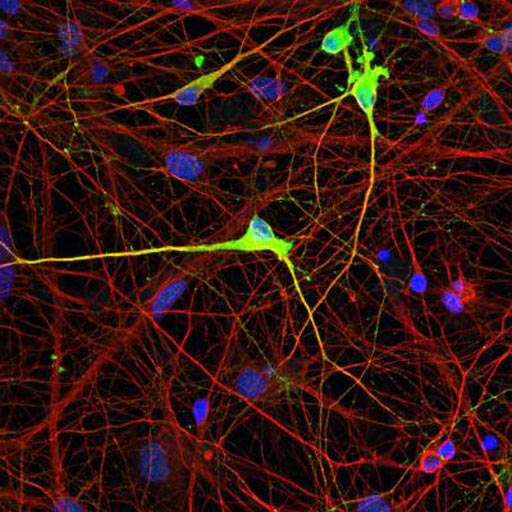 Image: Neurons from Angelman syndrome (AS) patients lack expression of the UBE3A protein due to an epigenetic defect. The photomicrograph shows that a new method restored normal expression of the UBE3A protein in neurons derived from the cells of an AS patient by correcting the aberrant methylation pattern (Photo courtesy of the Salk Institute for Biological Studies).