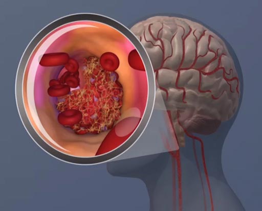 Image: Results published in a recent paper indicated that elevated levels of the protein beta-2 microglobulin in the blood were linked to an increased risk of ischemic stroke among women (Photo courtesy of the AHA).