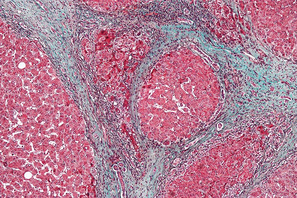 Image: A micrograph showing cirrhosis, a form of liver fibrosis (Photo courtesy of Wikimedia Commons).
