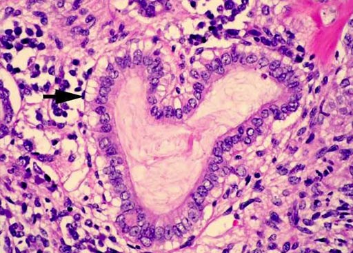 Image: A histopathology of Wilms tumor: the epithelial tubular structures may show mucinous differentiation as indicated. Ciliated epithelium and squamous metaplasia may also be seen (Photo courtesy of Pathpedia).