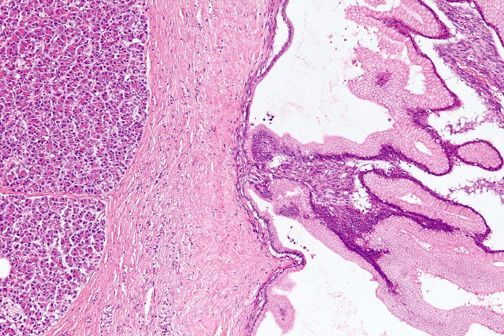 Image: Benign pancreatic mucinous cystic neoplasm (Photo courtesy of Wikipedia).