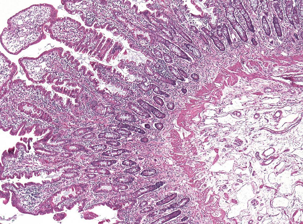 Image: This light microscope image shows the gut tissue of a child with CHAPLE disease. The large white areas in the bottom right corner are enlarged lymphatic vessels, which can contribute to intestinal distress (Photo courtesy of the US National Institute of Allergy and Infectious Diseases).