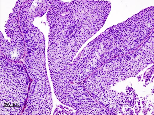 Image: A histopathology of urothelial carcinoma of the urinary bladder (Photo courtesy of Wikimedia Commons).