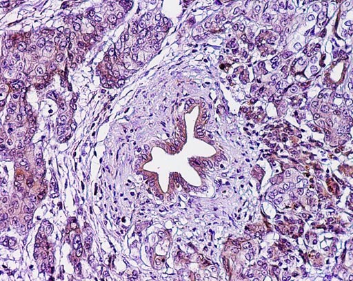 Image: A photomicrograph of pancreatic ductal adenocarcinoma (Photo courtesy of the Zaret Laboratory, University of Pennsylvania).
