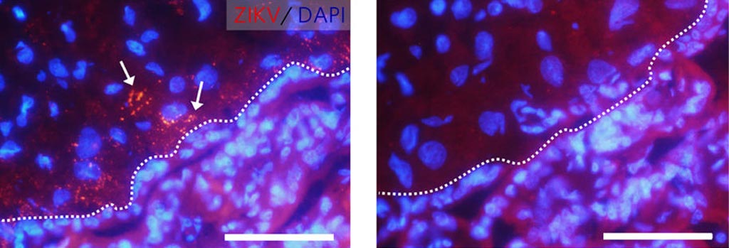 Image: Microscopy images taken of Zika-infected primate placenta samples that were stained to detect Zika by immunohistochemistry. The left image shows a sample treated with the EASE protocol, with red/orange colored signals of Zika infection clearly visible (white arrows). The right image shows a sample treated with a standard protocol, and Zika virus - though present - was not detected (Photo courtesy of the University of Washington).
