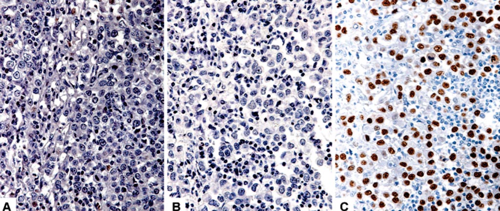 Image: Breast cancer: immunohistochemical comparison of three estrogen receptor antibodies: A through C, 1D5 and 6F11 show negativity, whereas SP1 shows positivity (Photo courtesy of Stanford University Medical Center).