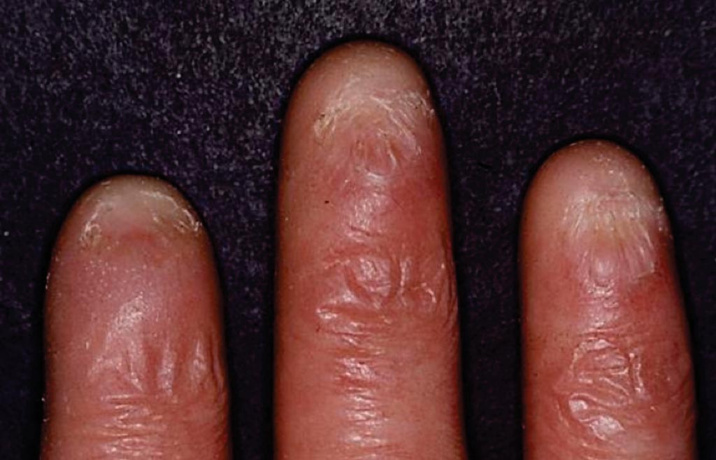 Image: Dyskeratosis congenita manifests as nail dystrophy where nail findings include ridging and longitudinal splitting. The nails may become thinned and atrophic leading to pterygium formation or absent nails. The changes in the fingernails and toenails may worsen over time (Photo courtesy of Dr. Maurice van Steensel).