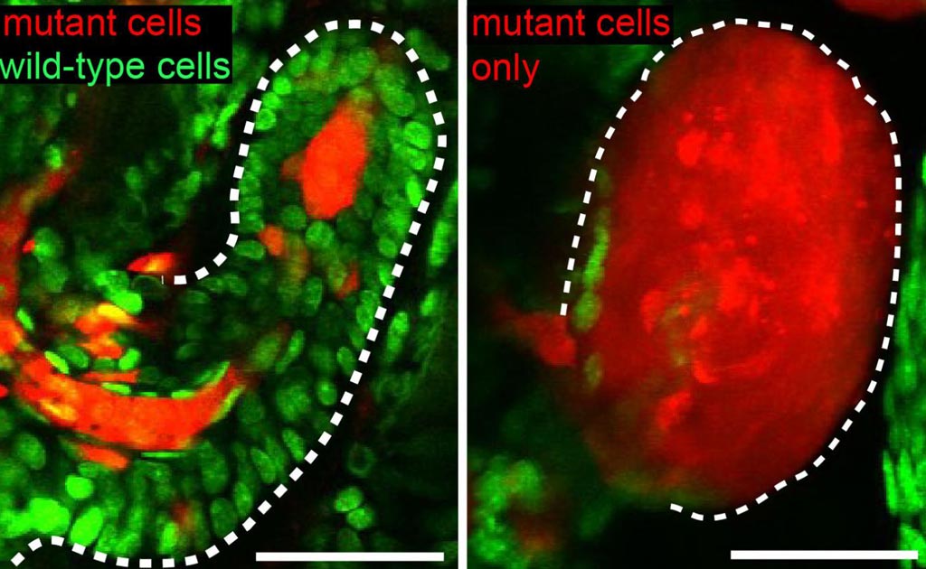 Image: Research shows normal cells help corral tumors (left) and when removed lead to expansion of cancers (Photo courtesy of Yale University).