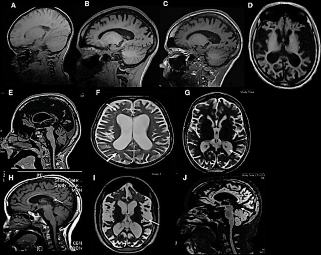Image: Brain scans from the study ‘Heterozygous de novo UBTF gain-of-function variant is associated with neurodegeneration in childhood’ (Photo courtesy of American Society of Human Genetics).