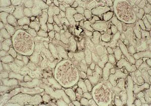 Image: A photomicrograph of brain tumor section (Photo courtesy of the Brain Tumour Research Centre, University of Portsmouth).