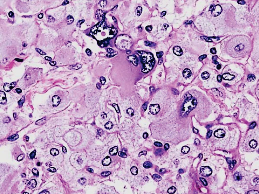 Image: A histopathology of adrenal pheochromocytoma from an adrenectomy specimen showing the characteristic stippled (finely granular) chromatin (Photo courtesy of Nephron).