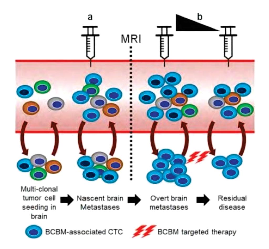 Image: The model illustrates clinical implications of BCBM CTC screening method for brain micro-metastasis before they become detectable by MRI. BCBM-associated CTCs can be used as a tool to evaluate responses to therapy for BCBM patients (Photo courtesy of Houston Methodist).