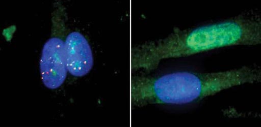 Image: Photomicrographs of muscle cells from a patient with myotonic dystrophy type I, untreated (left) and treated with the RNA-targeting Cas9 system (right). The MBNL1 protein is in green, repetitive RNA in red and the cell\'s nucleus in blue (Photo courtesy of the University of California, San Diego).