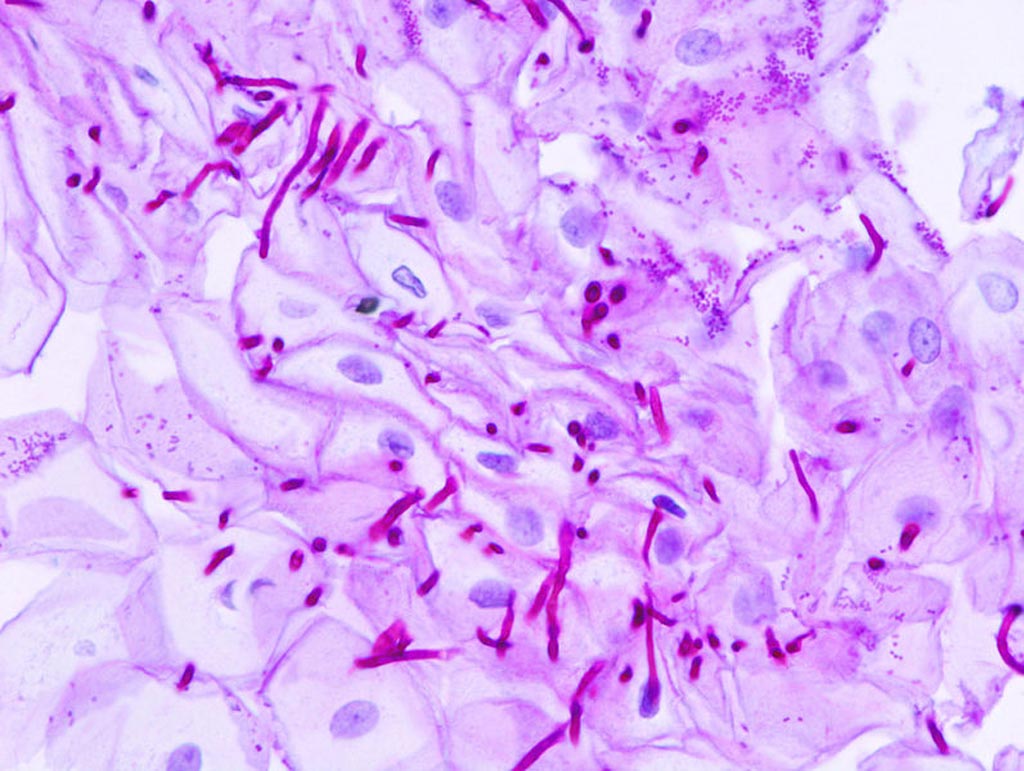 Image: A micrograph of esophageal candidiasis showing hyphae. Biopsy specimen stained by periodic acid-Schiff procedure (PAS stain) (Photo courtesy of Wikimedia).