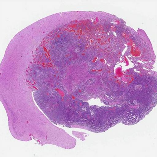 Image: A glioblastoma induced by the new gene-editing and screening technology (Photo courtesy Chen Lab, Yale University).